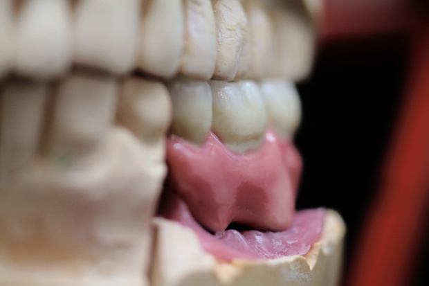 Implantátumos laterál híd extrém műíny kiképzéssel