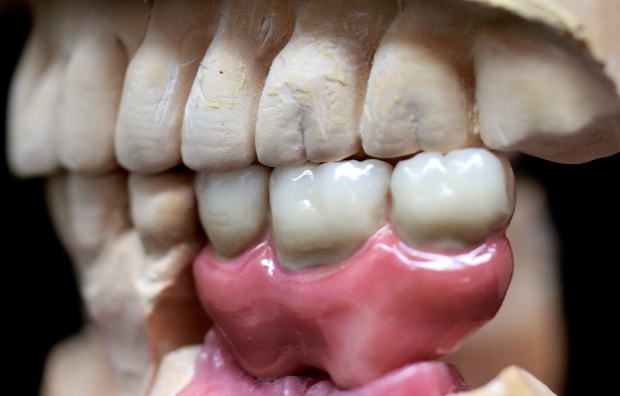 Implantátumos laterál híd extrém műíny kiképzéssel-3