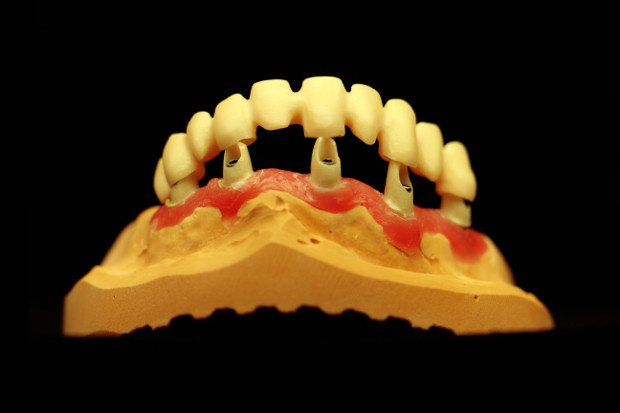 Egyedi cirkónium implant fejeken cirkónium körhíd