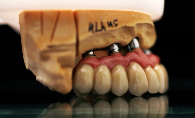 Felső, implantátumos, ragasztott, fémkerámia híd