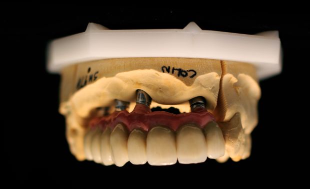 Felső, implantátumos, ragasztott, fémkerámia híd-3