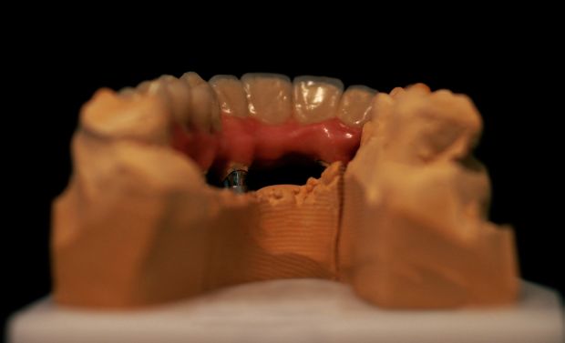 Felső, implantátumos, ragasztott, fémkerámia híd-4