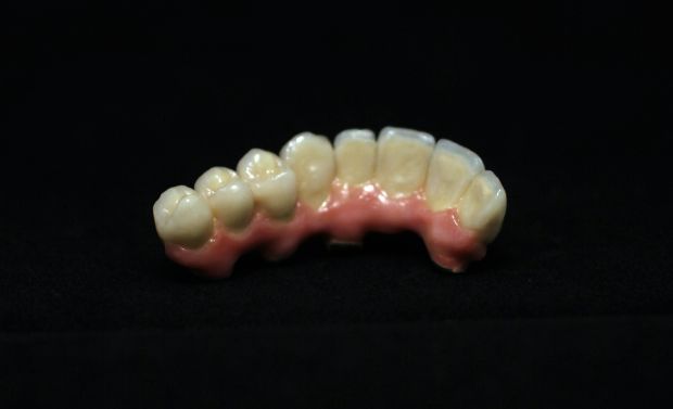 Felső, implantátumos, ragasztott, fémkerámia híd-5