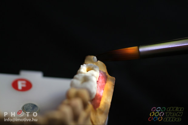 Csavaros rögzítésű cirkon implantátum koronák​