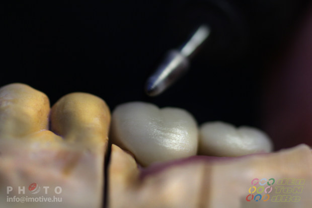 Csavaros rögzítésű cirkon implantátum koronák​-3