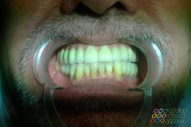 Intraocclusalisan csavarozott teljes felső implantátumos rehabilitáció matt próbán és átadáskor-4