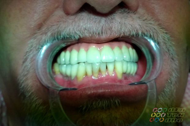 Intraocclusalisan csavarozott teljes felső implantátumos rehabilitáció matt próbán és átadáskor-5