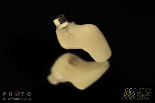Csavaros rögzítésű implantátumos cirkonkerámia szóló korona.-2