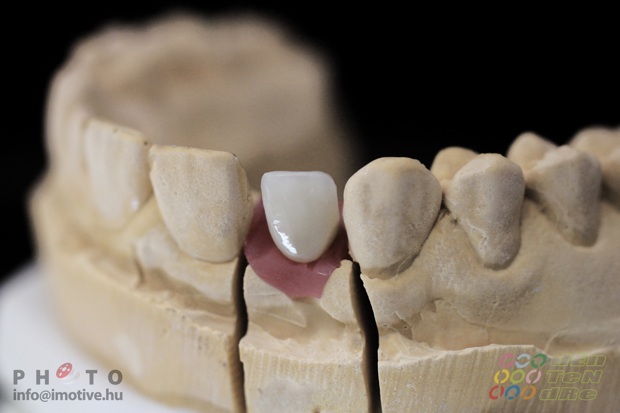 Csavaros rögzítésű implantátumos cirkonkerámia szóló korona.-4