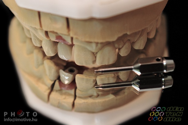 Csavaros rögzítésű implantátumos cirkonkerámia szóló korona.-5