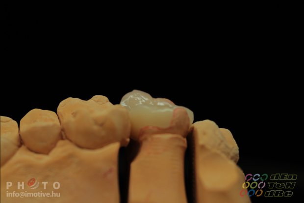 Grádia onlay-3
