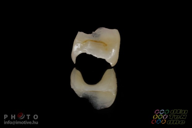 Grádia onlay-2