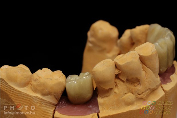 Implantátumos cirkonkerámia front híd lengőtaggal, csavaros rögzítésű cirkonkerámia szóló korona-5