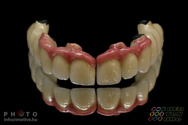 Felső implantátumos fémkerámia körhíd, kerámia műínnyel.-2
