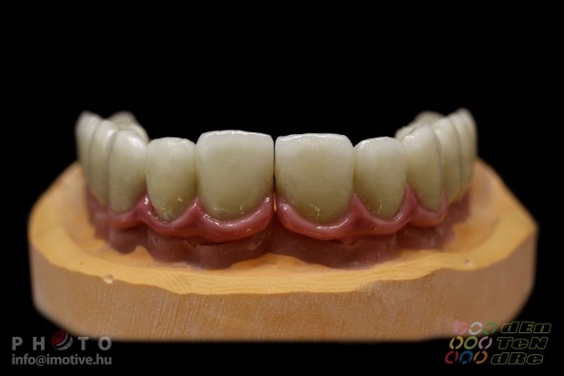 Felső implantátumos fémkerámia körhíd, kerámia műínnyel.-3