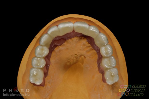 Felső implantátumos fémkerámia körhíd, kerámia műínnyel.-4