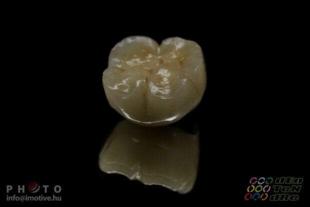 Alsó implantátumos szóló fémkerámia korona-2