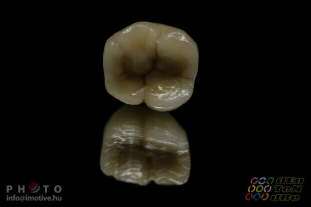 Alsó implantátumos szóló fémkerámia korona-4