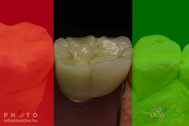 Alsó implantátumos szóló fémkerámia korona