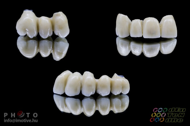 Alsó - felső implantátumos fémkerámia körhíd.