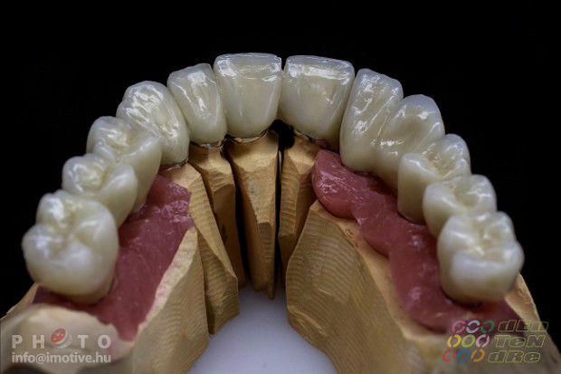 Alsó - felső implantátumos fémkerámia körhíd.-2