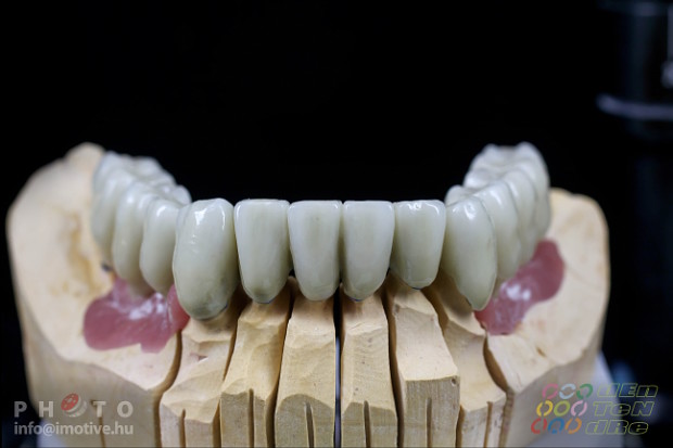 Alsó - felső implantátumos fémkerámia körhíd.-3