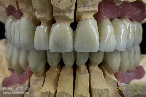 Alsó - felső implantátumos fémkerámia körhíd.-5